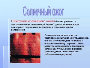 0026-026-Simptomy-solnechnogo-ozhoga-byvajut-raznye-ot-porozovenija-kozhi